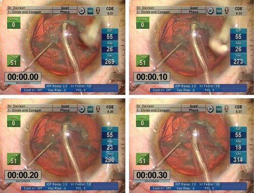 Figure 2 Video freeze frames from standard slow motion 30 frames/second video show the posterior capsule aspiration event.