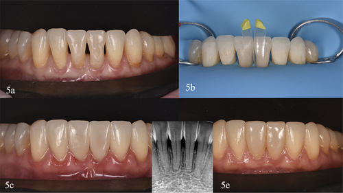 Figure 5. Clinical case III. (a) Initial lower intraoral front view. (b) Detail of the isolated teeth. The small yellow specific matrices for black triangles installed on the central black triangle (black triangle kit. Bioclear matrix systems. Bioclear) can be seen. (c) Immediate result just after removed the rubber dam. (d) Two weeks radiographic control (e) Two years review, highlighting the periodontal health and good polish of the restorations.