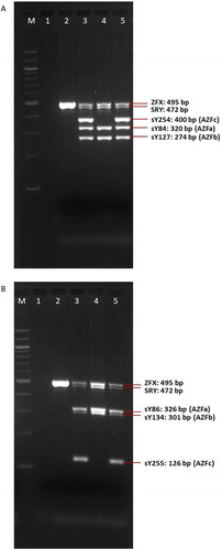 Figure 6. The results of multiplex-PCR-A (A) and multiplex-PCR-B (B) in control subjects and the patient showing intactness of Yp (SRY) and absence of Yq11.2 microdeletions in the AZFa, AZFb, and AZFc regions. M: marker (100 bp); 1: negative control; 2: control female; 3: control fertile male; 4: control infertile male (microdeletions in region AZFc – negative STSs sY254 and sY255); 5: patient