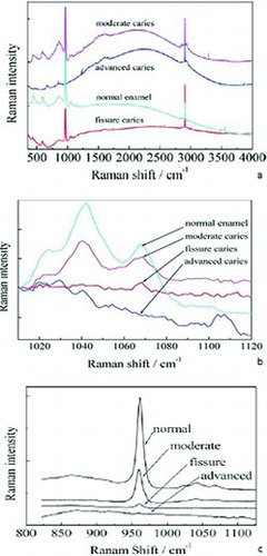 Figure 4 (a) Micro-Raman spectra of normal and carious enamel and Raman shifts at (b) carbonate region and (c) phosphate region. Courtesy of Bulatov et al. (Citation48).