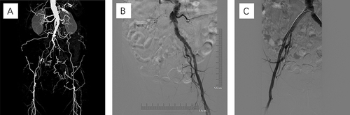 Figure 1 Imaging findings of a case with bilateral iliac artery occlusion. (A) Preoperative computed tomography angiography showed occlusion of bilateral iliac artery. (B) During the operation, the right iliac artery did not develop by angiography, and occlusion was confirmed. (C) The right iliac artery was recanalized after balloon angioplasty and stenting, and angiography confirmed that the vessel was in good condition without leakage.