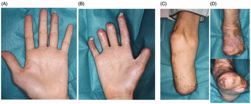 Figure 5. The condition at four months after the last surgery. All wounds had already healed completely. (A) The left hand, (B) right hand, (C) right foot, (D) left foot.