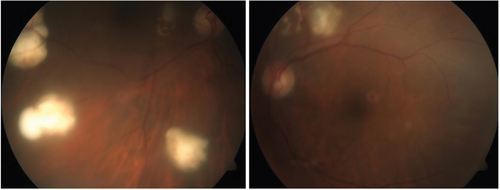 Figure 1. Fundus photograph showing bilateral chorioretinitis and progressive outer retinal necrosis.