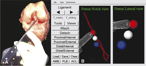 Figure 6. (A) Marking of the drill-hole location in the notch with a physical indent of the computer-tracked awl. (B) The red anatomic AM center is the target point for the mark by the transparent pedicle awl, as visualized on the CAS system monitor. Left: notch view; right: lateral-medial view.