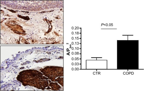 Figure 3 Area of positive staining for α-SMA standardized for basement membrane squared (A/PbmCitation2) in the biopsy specimens from CTR and COPD subjects.
