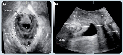 Figure 8. Identification of the plane of minimal hiatal dimensions in (A) an oblique axial plane as identified in the (B) midsagittal plane.This plane, while not always sufficient to diagnose avulsion injury, defines the levator hiatus, is used to determine hiatal dimensions and distensibility, and serves as a convenient reference plane for tomographic ultrasound imaging.