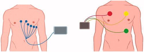 Figure 1. The placement of the ECG and PEM electrodes.