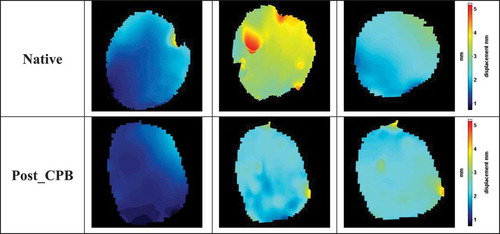 Figure 8. Displacement field images of the surgery #1 (a) Image number 10 of native stage, (b) Image number 15 of native stage, (c) Image number 17 of native stage, (d) Image number 10 of post-CPB stage, (e) Image number 15 of post-CPB stage, and (f) Image number 17 of post-CPB stage