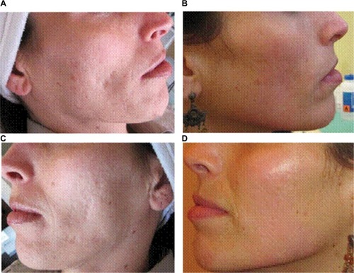 Figure 8 Result of an anterior-chemabrasion with Easy TCA®.