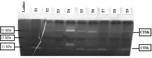 Figure 1 Cathepsin zymogram of tissue specimens in breast cancer. It shows 20 μg tumor tissue specimens from patients with breast cancer biopsies were loaded for zymography. Cathepsin K band were visible at 37 kDa and cathepsin L at 21 kDa based on the standards molecular weight of CTSK and CTSL shown on the left panel (ladder).