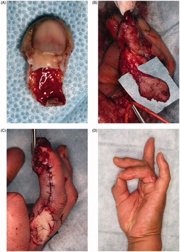 Figure 2. (A) Avulsed left ring finger tip. Intensely crushed. (B) Raising of a reverse digital artery flap. (C) Flap applied to the fingertip, with the avulsed finger skin grafted to the donor site. (D) At 6 months after surgery, there is favorable fingertip form and no contracture.