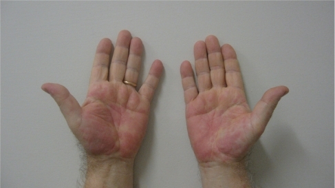 Figure 2 The lesions involved also the palmar aspect of both hands with edema and pain.