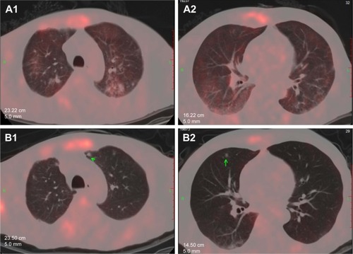 Figure 2 The progression in the lung. (A1 and A2) were taken on October 9, 2015. (B1 and B2) were taken on December 10, 2015, and the green arrows refer to the new lesions.