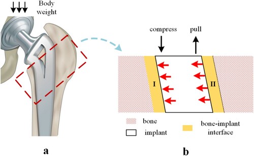 Figure 19. Hip stem implantation: (a) implant and bone assembly, (b) local enlargement of hip joint stem deformation.