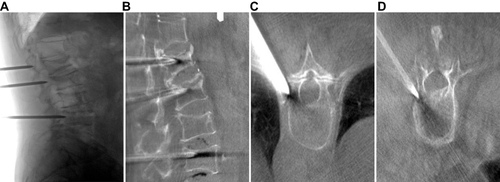 Figure 1 Multivertebral sequence puncture, DSA scan reconstruction after precise adjustment of puncture needle position for PKP imaging. (A) Multi-vertebral sequence puncture DSA scanning lateral position. (B) DSA scanning reconstruction of sagittal position. (C) Reconstruction of thoracic vertebral cross-section by DSA.(D) DSA scanning of the lumbar cross-section.