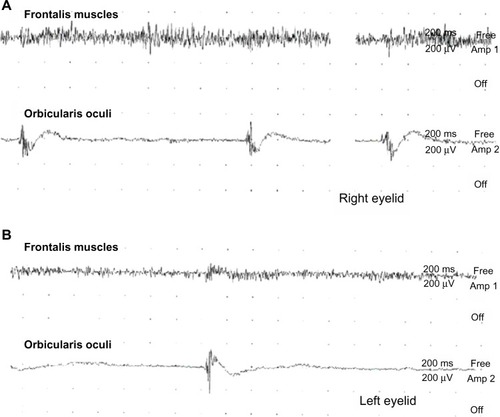 Figure 2 Surface electromyography was recorded at the bilateral eyelids: (A) right frontalis and orbicularis oculi muscles; (B) left frontalis and orbicularis oculi muscles. Persistent contraction of the frontalis muscle was observed, while there was rare contraction of the orbicularis oculi muscle when the patient tried to open her eyes.