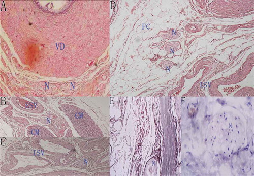 Figure 4. Histological sections showing the neural morphology and distribution in the sperm cord. VD: vas deferens, N: nerve fibers, CM: cremaster, ISV: internal spermatic vessels, ESV: external spermatic vessels, FC: fat cells. (A) A histologic transverse section of vas deferens under light microscopy (HE staining, ×4) showing nerve fibers located around the vas deferens. (B) A histologic transverse section of external spermatic compartment under light microscopy (HE staining, ×4) showing nerve fibers located between muscles. (C) Nerve fibers around the internal spermatic vessels under light microscopy (HE staining, ×4). (D) Nerve fibers in adipose tissue under light microscopy (HE staining, ×4). (E & F) Nerve fibers under light microscopy stained by silver staining and immunohistochemical staining (Mouse anti-human S100 monoclonal antibody, ×4).