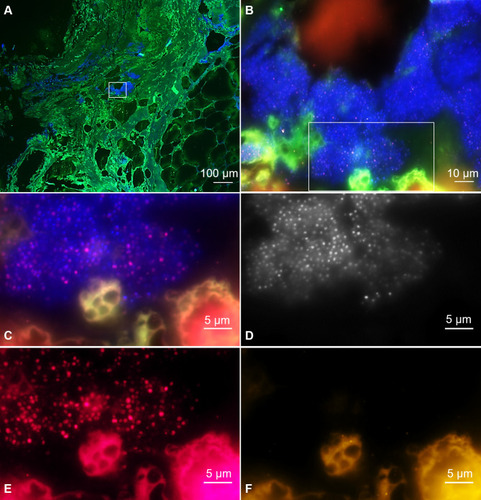 Figure 5 FISH analysis of deep sternal wound tissue. A Overview of the tissue (green) with regions of bacterial biofilms (blue). Green – autofluorescent tissue background, blue – nucleic acid stain DAPI staining bacteria and host nuclei. (B) Magnification of the biofilm. Orange – pan-bacterial probe EUB338-Cy3. Identification of the bacteria as staphylococci by FISH is shown in (C–F). Here, the same inset as in B is shown with different fluorochrome filter sets. (C) overlay of DAPI (blue) and the STAPHY-probe specific for Staphylococcus sp. (magenta, Cy5). (D) DAPI in black and white for better contrast shows all cocci. (E) – STAPHY-Cy5 in magenta shows staphylococci. (F) The Enterococcus sp.-specific probe combination ENFA/EFAEC shows no signal in orange (Cy3) excluding the presence of enterococci. Note the autofluorescent tissue structure in the right lower corner that shows fluorescent signals in both Cy 3 and Cy5.