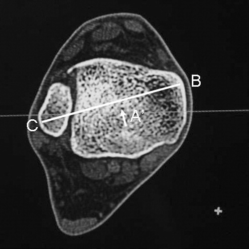 Figure 3. Illustration showing how the mid-point of the ankle joint in the sagittal plane (A, illustrated on a coronal view) passes posterior to the axis joining the most prominent points on the medial (B) and lateral (C) malleoli.