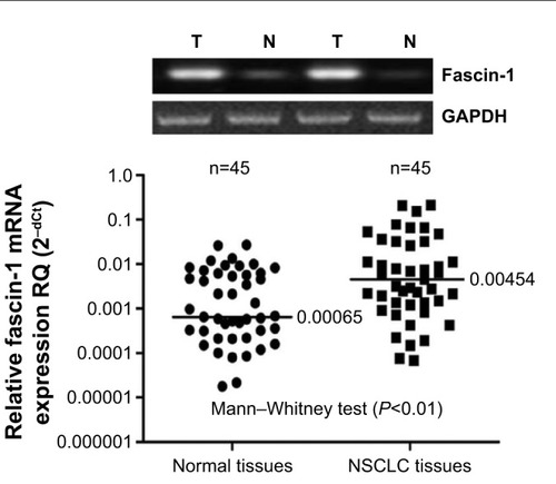 Figure 2 Fascin-1 mRNA was detected by RT-PCR.