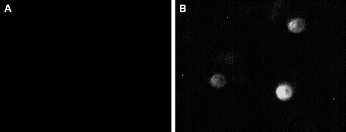 Figure 1. Immunofluorescence staining of podocytes in urine from normal controls (A) and DKD patients (B). Fluorescence indicated podocalyxin-positive cells (200 ×).
