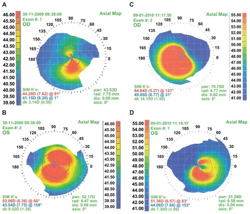 Figure 1 Corneal topography images of patient 1 (A) right eye and (B) left eye and patient 2 (C) right eye and (D) left eye.