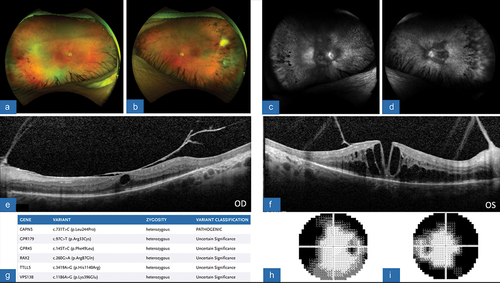 Figure 3. (A/B) color fundus photograph, OD/OS, with vitreous haze overlying superior traction and temporal pigmentary retinopathy. (C/D) FA, OD/OS, revealing diffuse leakage around the disc as well as along vessels, along with patchy areas of nonperfusion correlating with inner areas of pigmentary retinopathy. (E/F) OCT macula, OD/OS, demonstrating severe macular traction in both eyes and cystoid macular edema. (G) SPARK genetic testing showing gene mutations and variants, consistent with pathogenic CAPN5 mutation. (H/I) HVF 30–2, OD/OS, revealing peripheral constriction in both eyes with the left eye more severely affected and then the right with remaining central island.