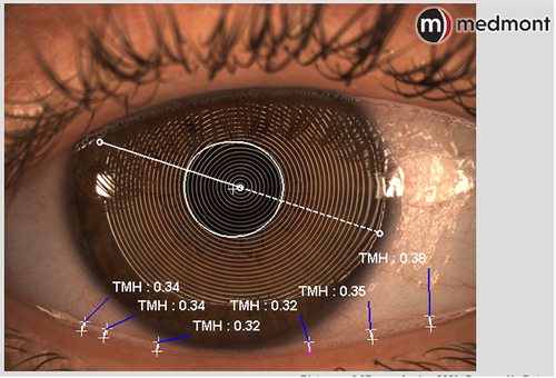 Figure 12 Lower tear meniscus height (TMH) measurements. The values are >0.2mm, indicating a normal amount of tears over the ocular surface.