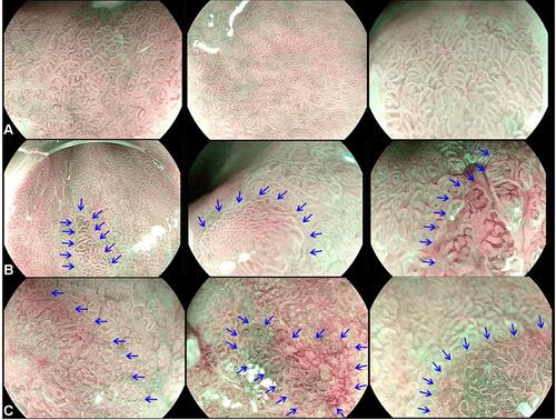Figure 1 Magnified endoscopic view of esophageal mucosa of (A) Regular mucosal pattern and regular vessels that follow the architecture of the mucosa. (B) Change in the microsurface and/or microvasculature from background mucosa with demarcation marked by blue arrows. (C) Irregular microsurface and/or microvascular patterns with demarcation marked by blue arrows.