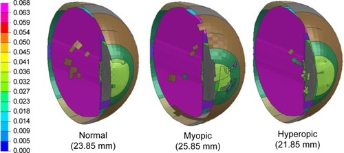 Figure 7 Sagittal view of the model eye at 0.3 ms after the airbag impact.