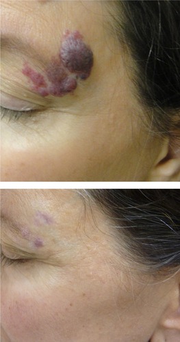Figure 2 An adult woman with a previously untreated capillary malformation at the left temple that had developed darkening and nodularity.