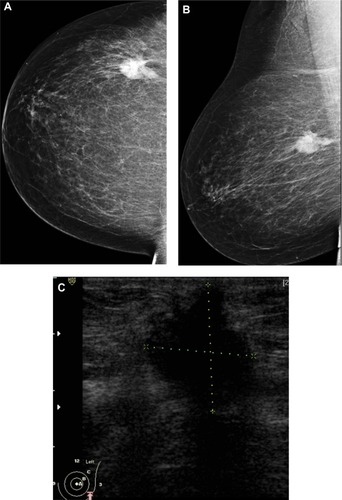 Figure 4 A 72-year-old female with left breast mass. (A and B) Craniocaudal and mediolateral mammogram of left breast revealed an irregular spiculated, dense mass (35 × 25 mm) in the upper outer quadrant close to the pectoral muscle. Single benign macrocalcification is noted in the central area. (C) Ultrasound of the left breast revealed a spiculated, hypoechoic, solid mass (30 × 23 mm) with strong acoustic shadow at 3–4 o’clock.