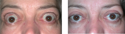 Figures 9 (left) and 10 (right) Pre- and post-operative eyelid retraction repair images document improvement of eyelid position.