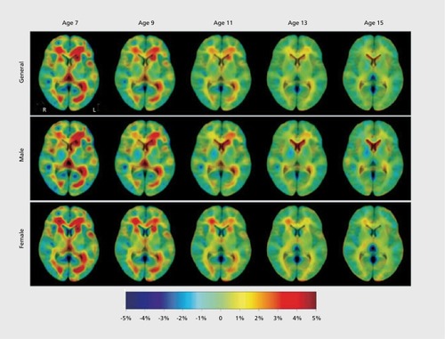 Supplementary Figure 1. Gray matter maturation between ages 7-15. Tissue growth maps modeled by linear regression, for all subjects and males and females separately. Reproduced from ref 31: Hua X, Leow AD, Levitt JG, Caplan R, Thompson PM, Toga AW. Detecting brain growth patterns in normal children using tensor-based morphometry. Hum Brain Mapp. 2009;30:209-219. Copyright © Wiley-Liss 2009