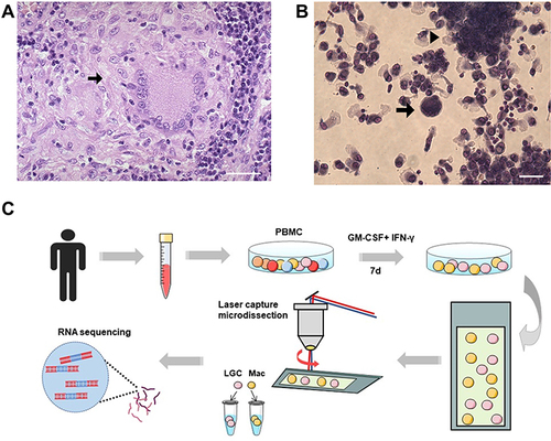 Figure 1 Formation and isolation of human LGCs. (A) Representative pathological image of a cutaneous tuberculosis case showing LGC (arrow) in granuloma. Hematoxylin and eosin stain. Scale bar, 100 μm. (B) In vitro granuloma model (arrowhead) induced by rhGM-CSF plus rhIFN-γ for 7 days. LGC formation was also observed (arrow). Scale bar, 50 μm. (C) Schematic diagram of human LGC induction and isolation in vitro for RNA sequencing.
