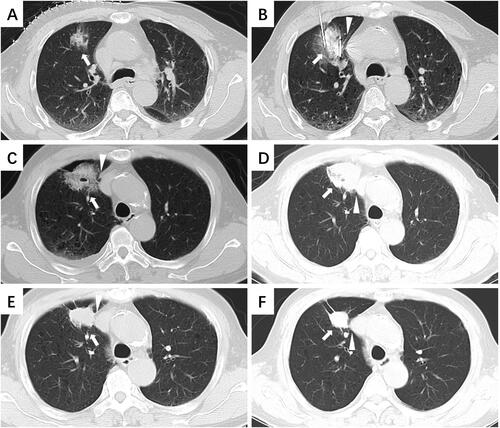 Figure 5. Structural changes: thickening of the mediastinal layers. (A) An 18-mm mixed ground-glass nodule (white arrow) was closer to the mediastinum without an end-inspiratory hold (lesion near the mediastinum within 10 mm). (B) In the supine position, the antenna punctured the center of the tumor parallel to the mediastinum. The minimum distance between the ablation antenna and mediastinum was less than 10 mm [triangular arrow]. (C) CT performed 24 h after the procedure revealed pleural effusion and further thickening of the mediastinal layers (triangular arrow). (D) CT 1 month after the procedure: The ablation area completely covered the tumor, and there was indistinct separation from the mediastinum layers. (E) CT 6 months after the procedure: Local thickening of the mediastinal layers. (F) CT performed 16 months after the procedure: The mediastinal layers returned to almost normal.