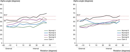 Figure 3.  Graphs showing the relationship between rotation and alpha angle in the ten cadaver femora. The data are presented in 2 graphs to facilitate visual interpretation. There are four normal femora and one pistol-grip (cam) femur in each graph. The horizontal dotted lines represent 1 and 1.96 standard deviations above the mean.