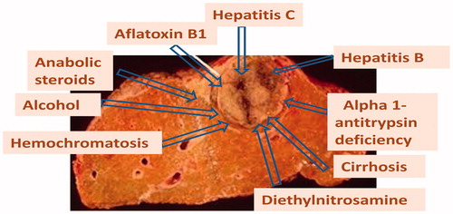 Figure 1. Causes of hepatocellular carcinoma.