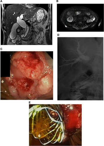 Figure 1 A 69-year-old presented with abdominal pain and cholestasis. MRI showed a double duct sign and a suspected lesion at the papillary area (A), presenting an abnormal diffusion-weighted signal and suggestive of an ampulloma (B). ERCP revealed an ampullary mass (C) and standard biopsies were performed confirming the diagnosis of ampullary carcinoma. A 10mm USEMS of 6 cm of length is placed to relieve the obstruction (D, E).