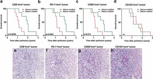 Figure 4. High tumor infiltration of CD8+ and CD68+ cells correspond to longer overall survival. A dichotomization of uveal melanoma patients based on above or below median infiltration of (a) CD8+ cells, (b) PD-1+ cells, (c) CD68+ and (d) CD163+ cells in liver metastases obtained prior to IHP correlated to overall survival (n = 14, log-rank test). Representative immunostainings from the same area in consecutively sectioned slides for (e) CD8, (f) PD-1, (g) CD68 and (h) CD163. Normal liver tissue is shown to the right part of each image