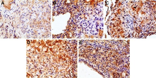 Figure 12 Immunohistochemical staining for VEGF of orthotopic tumors in all the groups.Notes: (A) Positive group, (B) combination group, (C) test group, (D) reference group, and (E) model group. Magnification ×400.Abbreviation: VEGF, vascular endothelial growth factor.