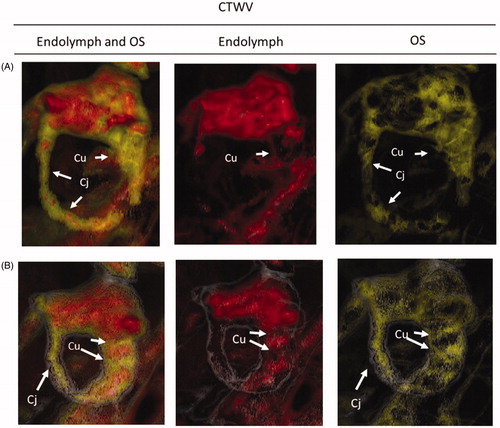 Figure 4. Two patterns of cupulolithiasis that are totally (A) or partially (B) occluded with OS (yellow color). (A) No dizzy healthy subject with totally occluded cupulolithiasis. (B) Dizzy patient with partially occluded cupulolithiasis. The ampulla of no-dizzy healthy subject with cupulolithiasis is totally occluded with OS (yellow color). Cj: canalith jam; Cu: cupulolithiasis. CTWV: CT window value; OS: otoconia-like substance.