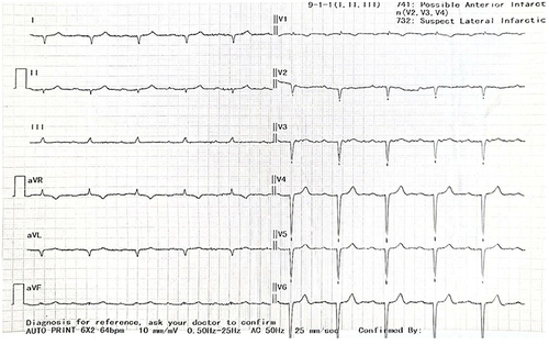 Figure 1 Twelve lead electrocardiography showing sinus rhythm with first-degree AV block, low voltage limb leads, extreme right axis deviation, and absent R wave progression.