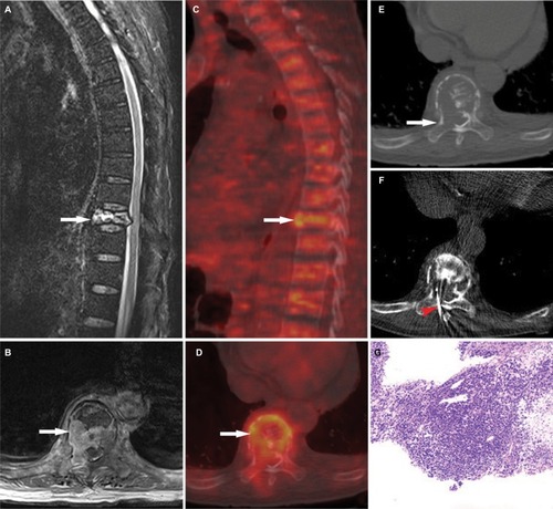 Figure 3 A 58-year-old man with compression fracture in the ninth thoracic vertebra (T9). (A, B) Magnetic resonance imaging shows the posterior cortical bulging on sagittal view (A, arrow indicated) and pedicle involvement on axial view (B, arrow indicated). (C, D) 18F-FDG PET/CT imaging shows increased FDG uptake in the bone marrow (arrow indicated, SUVmax = 3.50). (E, F) CT-guided percutaneous biopsy is subsequently performed and the T9 lesion (arrow indicated) is chosen as the biopsy target (E). Axial noncontrast CT image shows the biopsy needle (red arrow indicated) positioned within the right side of the lesion (F). (G) Histological examination confirmed the bone lesion as the solitary plasma cell myeloma. Magnification ×100.Abbreviations: 18F-FDG, 2-[fluorine-18]-fluoro-2-deoxy-D-glucose; PET, positron emission tomography; CT, computed tomography; SUVmax, maximum standardized uptake value.