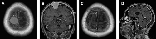 Figure 1 Preoperative contrast-enhanced T1-weighted MR images in the axial (A) and coronal (B) planes of a 71-year-old woman operated on for a parasagittal meningioma. Last follow-up MRI examination obtained after Simpson grade III resection of a fibroblastic meningioma (WHO grade I) showed no recurrence in contrast-enhanced T1-weighted images in the axial (C) and sagittal (D) planes.