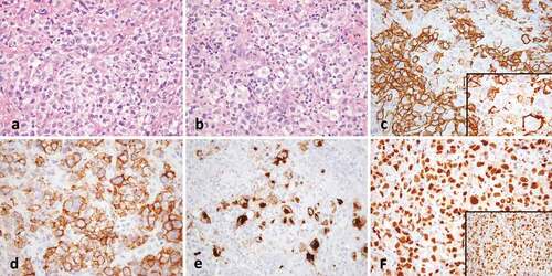 Figure 1. Gray-zone lymphoma. (a) There is a diffuse infiltrate of atypical lymphoid cells with clear cytoplasm (40x). (b) Occasional cells have Hodgkin-like features (40x). (c) CD20 shows strong staining with some variability (40x, inset 100x). (d) CD30 is strongly positive and (e) CD15 shows golgi and membranous staining in a subset of Hodgkin-like cells (both 20x). (f) OCT2 (40x) and PAX-5 (inset, 40x) are strongly positive.