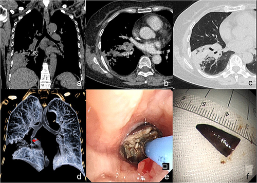 Figure 4 A 70-year-old woman with cough and expectoration for 6 months and definite history of pepper aspiration. Coronal CT image shows localized soft tissue density opacification (arrow) at the opening of anterior basal segment bronchus of the right lower lobe (a). On axial CT image, it has no significant enhancement (arrow), and enlarged lymph node (asterisk) at right hilum (b) as well as distal consolidation and nodules could be detected (c). Volume rendering image (d) shows occlusion and stenosis (arrow) of the right lower lobe bronchi and distal bronchiectasis. Bronchoscopy examination shows red foreign body containing secretion (e) in the opening of the bronchus. Finally, the foreign body is revealed as pepper shell (f).