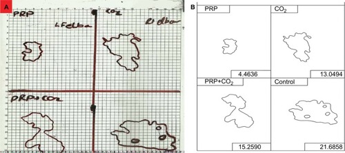 Figure 1 (A) Point counting: example grid for vitiligo lesion. The total area of the lesion was estimated by multiplying 0.1 cm2 by the number of points. (B) Digital planimetry technique: calculation of changes in the vitiligo patch size by AutoCAD 2016, version 20.1.