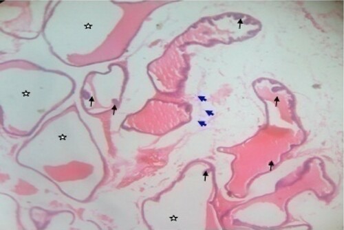 Figure 4. Photomicrograph of prostate tissue section of a rat from group 4 (BPH-induced and treated with 200 mg/kg of CME) showing mild focal adenoma with areas of atypical hyperplasia and mild squamous papilloma appearances. H&E. mag. 400X.