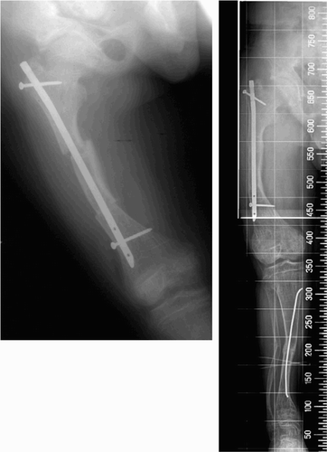 Figure 1. Acute deformity correction after double-level osteotomy of the femur with an intramedullary nail (left).There was no mechanical axis deviation of the whole extremity, but the varus deformity was starting at the metaphysis of the distal femur (right).